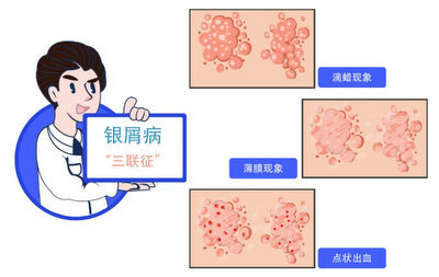 合肥银屑病医院哪家好